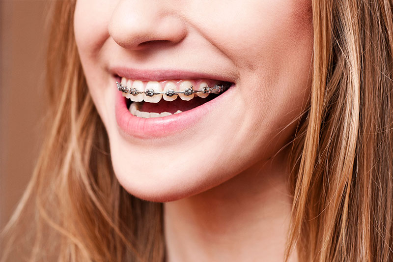 Orthodontics in Seattle